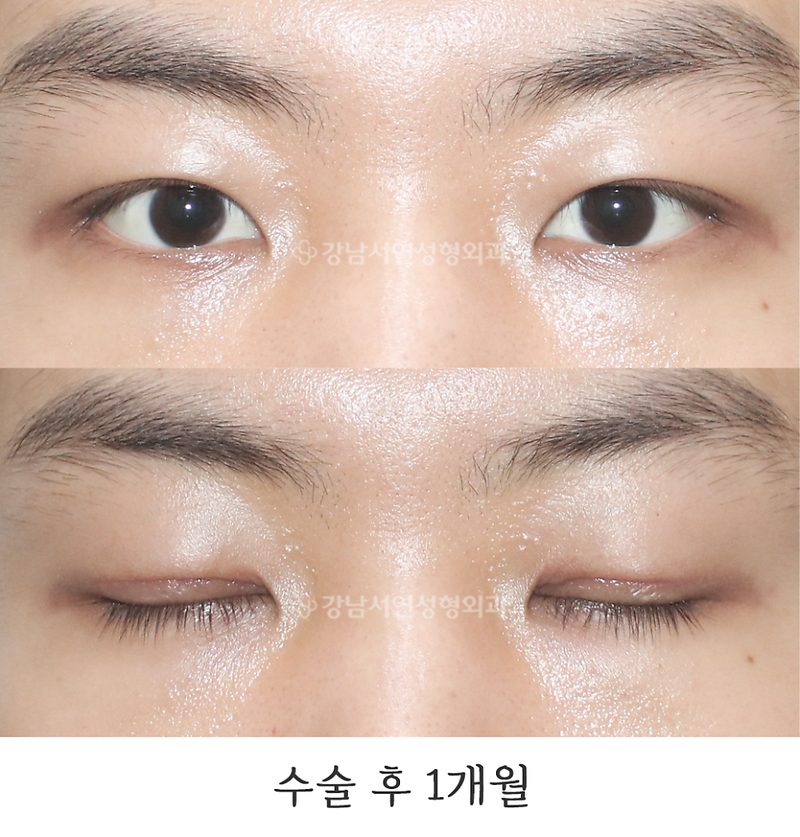 강남서연성형외과의원 남자눈매교정 전후 사진