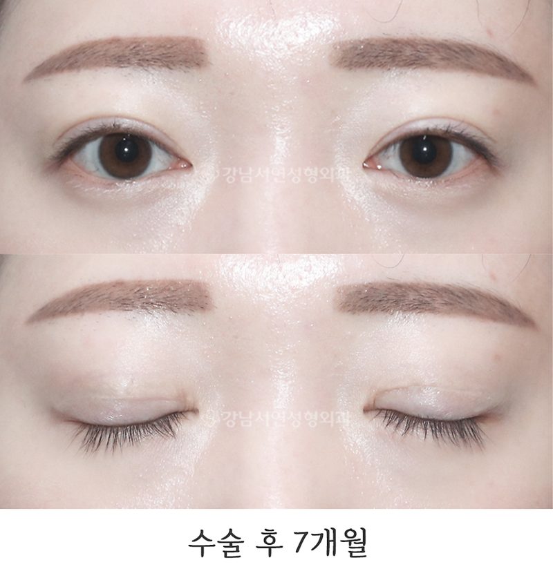 강남서연성형외과의원 안검퇴축, 두줄따기 전후 사진