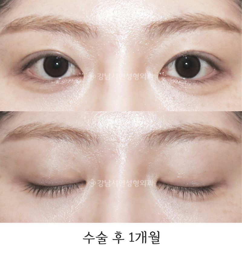 강남서연성형외과의원 쌍꺼풀 라인 낮추기 재수술 전후 사진