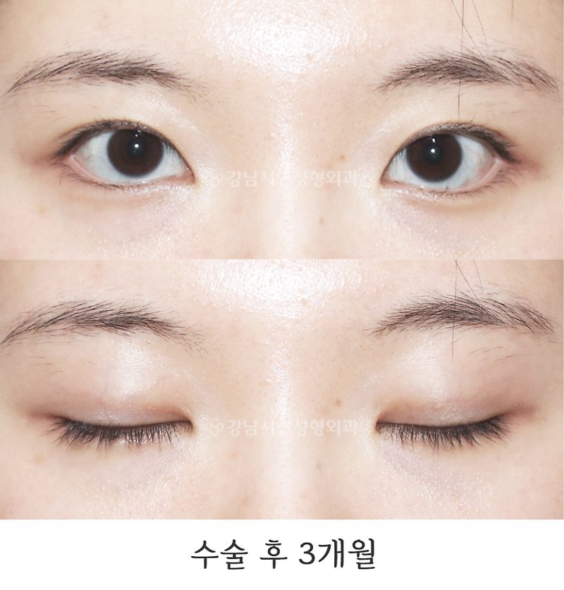 강남서연성형외과의원 매몰쌍꺼풀, 겹주름 교정 전후 사진