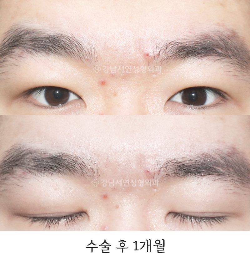 강남서연성형외과의원 남자눈매교정 전후 사진