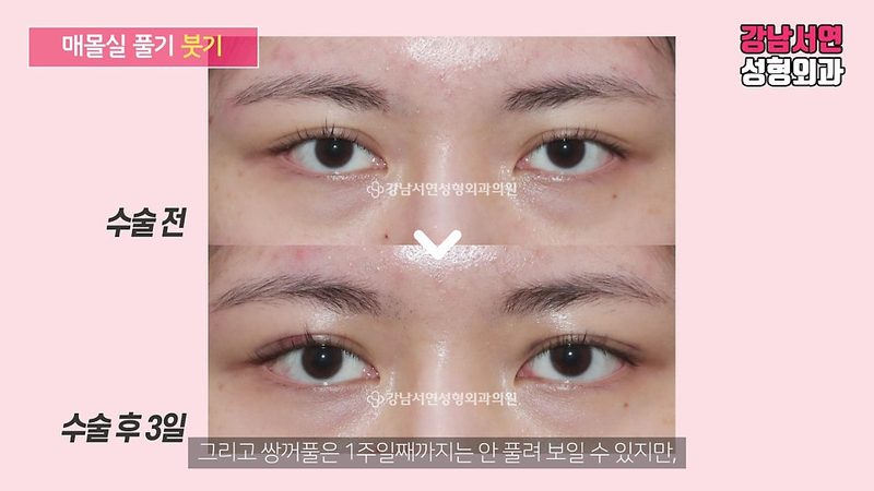 매몰실 풀기, 매몰 풀기, 매몰실 제거 제대로 알아보자
