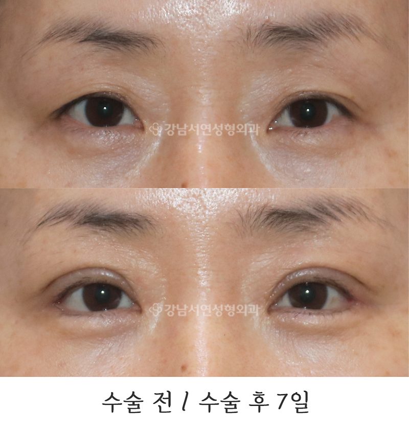강남서연성형외과의원 상안검, 뒤밑트임 전후 사진