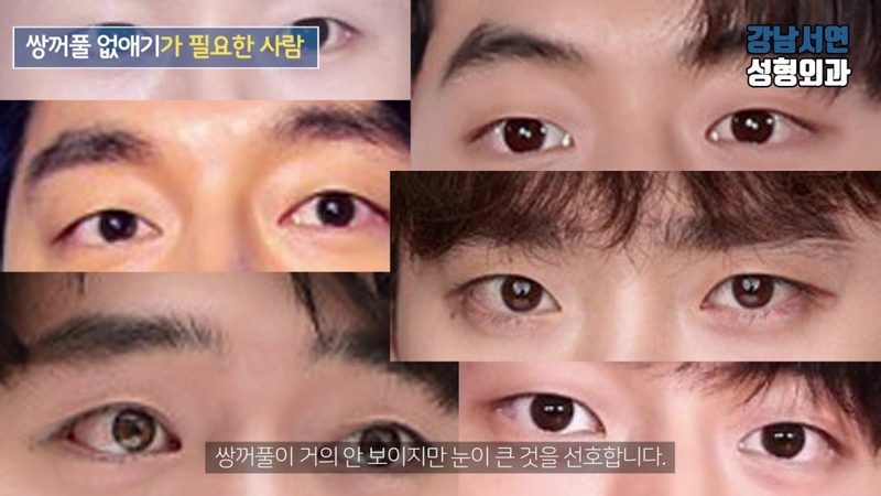 남자 쌍꺼풀 없애기 수술 방법, 유의할 점, 전후사진