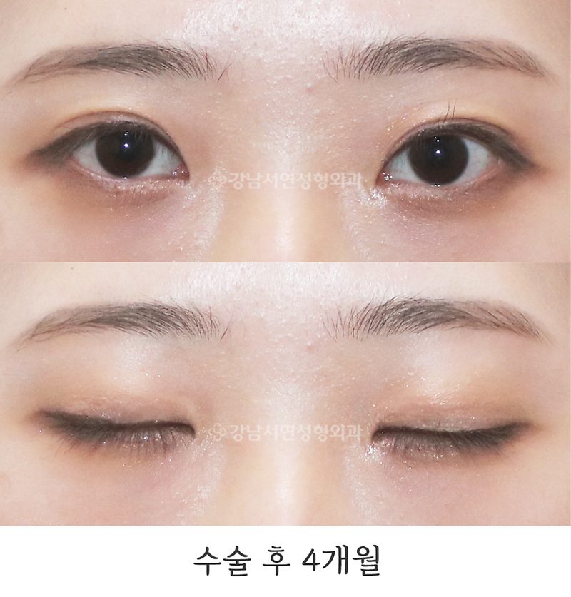 강남서연성형외과의원 쌍꺼풀 재수술(점막들림, 짝눈교정) 전후 사진