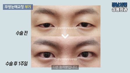 남자 무쌍눈매교정 수술방법과 전후사진