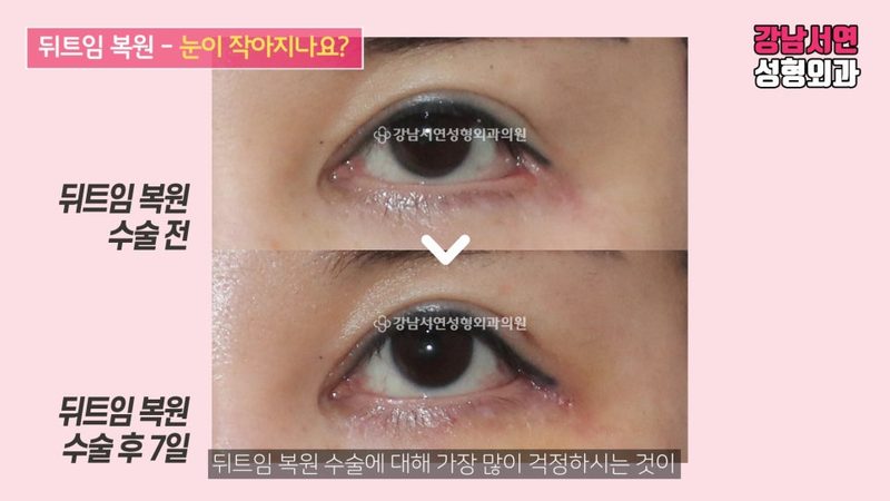 뒤트임 복원 수술방법과 전후사진