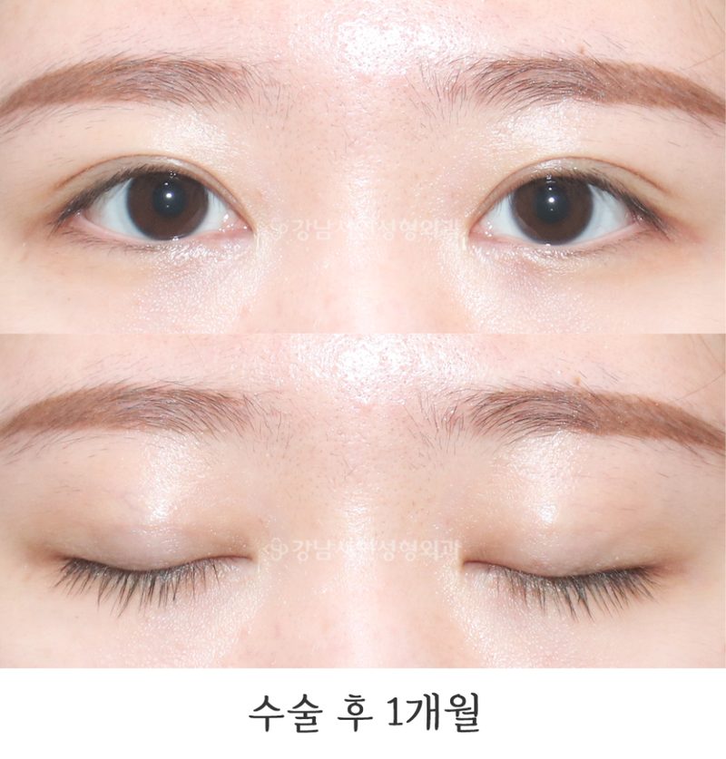 강남서연성형외과의원 매몰 쌍꺼풀 재수술 전후 사진