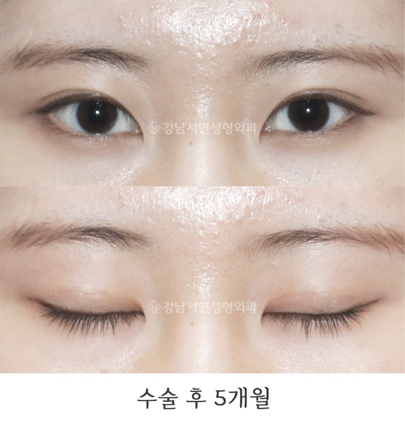 강남서연성형외과의원 두줄따기, 라인낮추기 전후 사진
