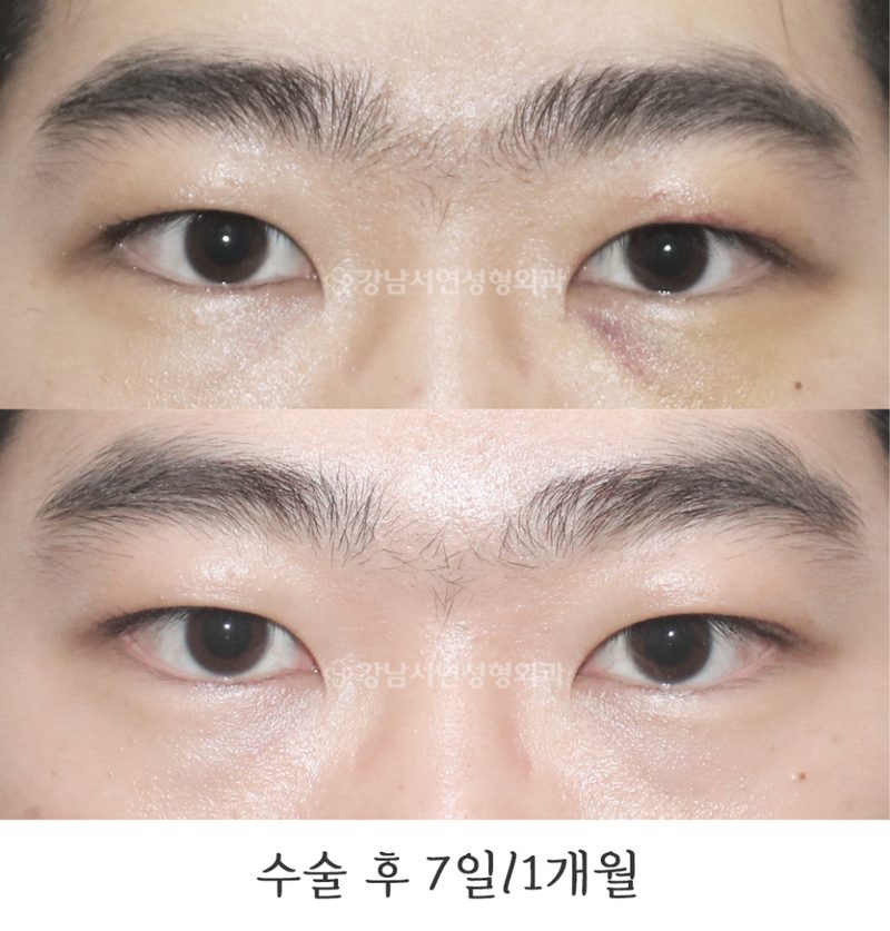 강남서연성형외과의원 남자무쌍눈매교정 속쌍눈매교정 전후 사진