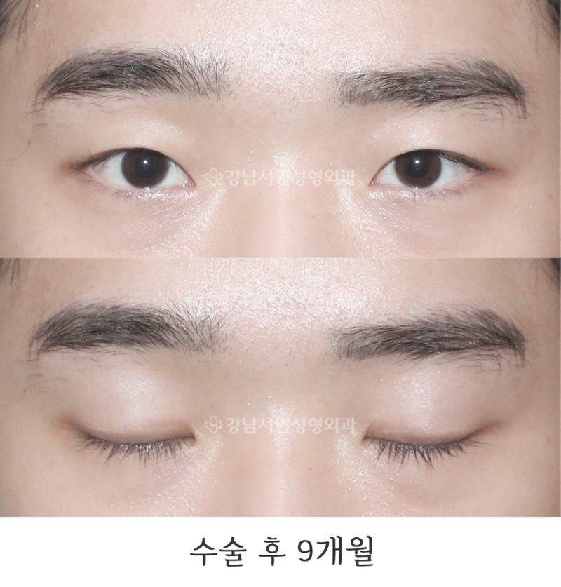 강남서연성형외과의원 남자 무쌍 속쌍눈매교정 전후 사진