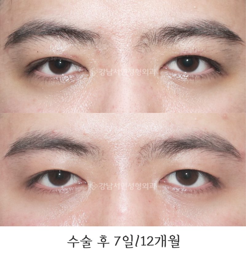 강남서연성형외과의원 남자 쌍꺼풀 라인 낮추기 두줄따기 전후 사진