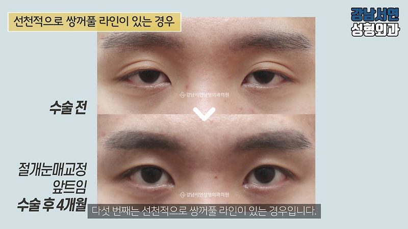 남자 비절개눈매교정 하면 안되는 이유
