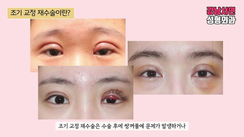쌍꺼풀 조기교정 재수술 언제 해야할까?