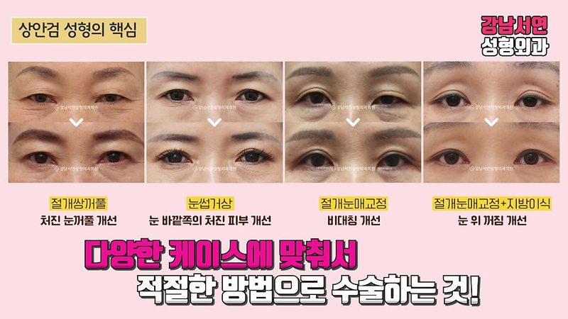 자연스러운 상안검 성형의 모든 것 수술전후 후기까지!