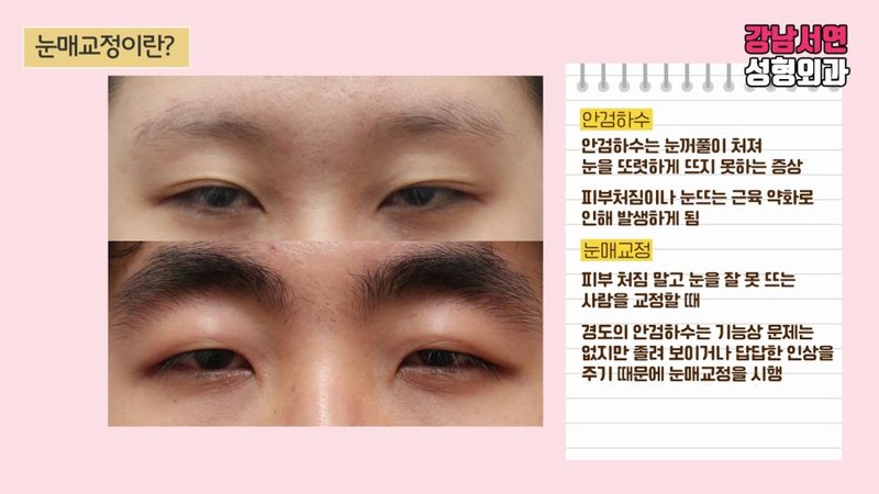눈매교정 부작용과 그 원인, 제대로 알아보자!