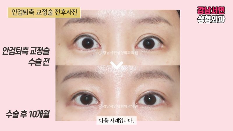 안검퇴축 정확한 뜻과 전후사진