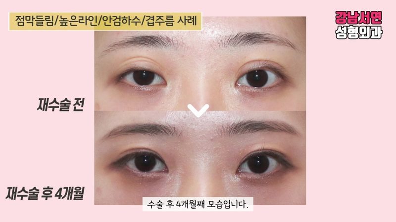 겹주름, 점막들림, 안검하수 재수술 후 4개월