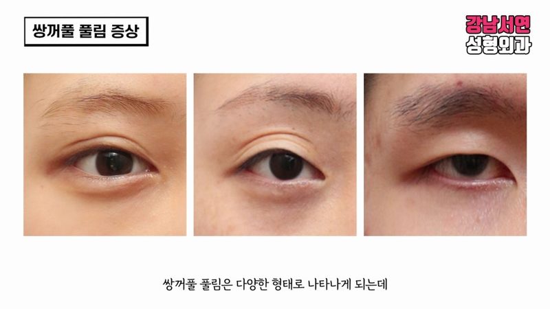 쌍꺼풀 풀림 원인과 해결방법