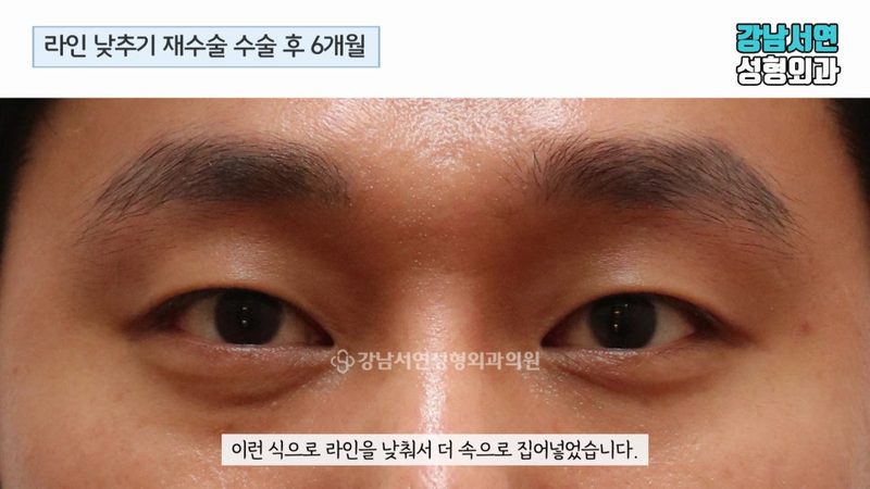 남자눈매교정 실제 수술 전후 사례로 알아보자
