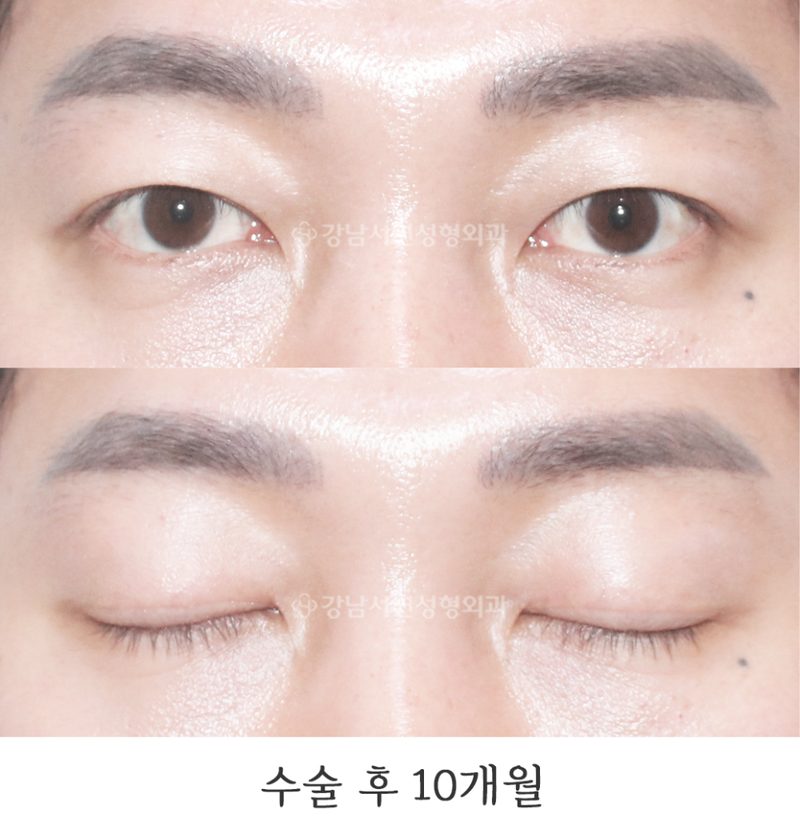 강남서연성형외과의원 남자눈매교정, 겹주름 교정 전후 사진
