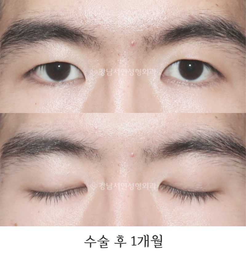 강남서연성형외과의원 매몰 실풀기, 매몰 실제거 전후 사진