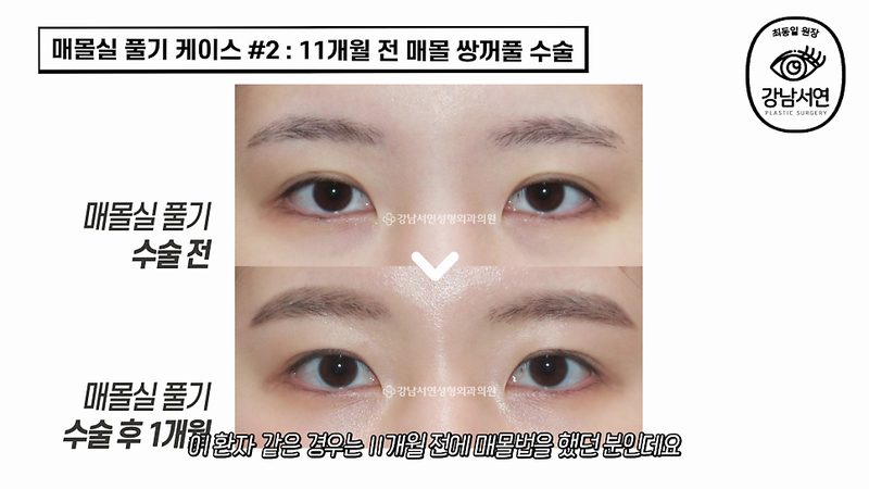 매몰실 풀기, 매몰실 제거 다양한 케이스 성공 후기