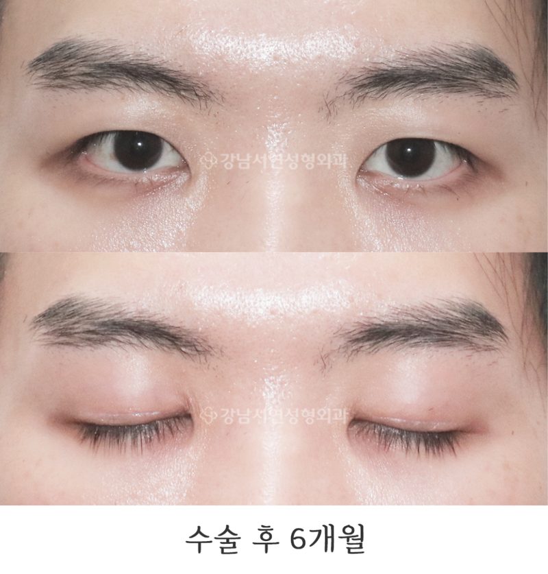 강남서연성형외과의원 남자무쌍눈매교정 전후 사진
