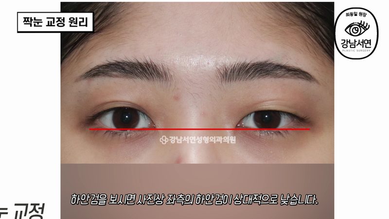 눈 성형 전문의의 짝눈 교정 원리와 성공 후기