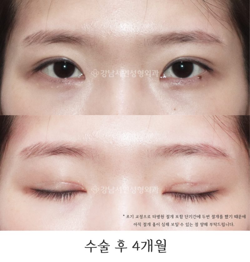 강남서연성형외과의원 절개 눈매교정 과교정 조기교정 (눈 당김 개선) 전후 사진