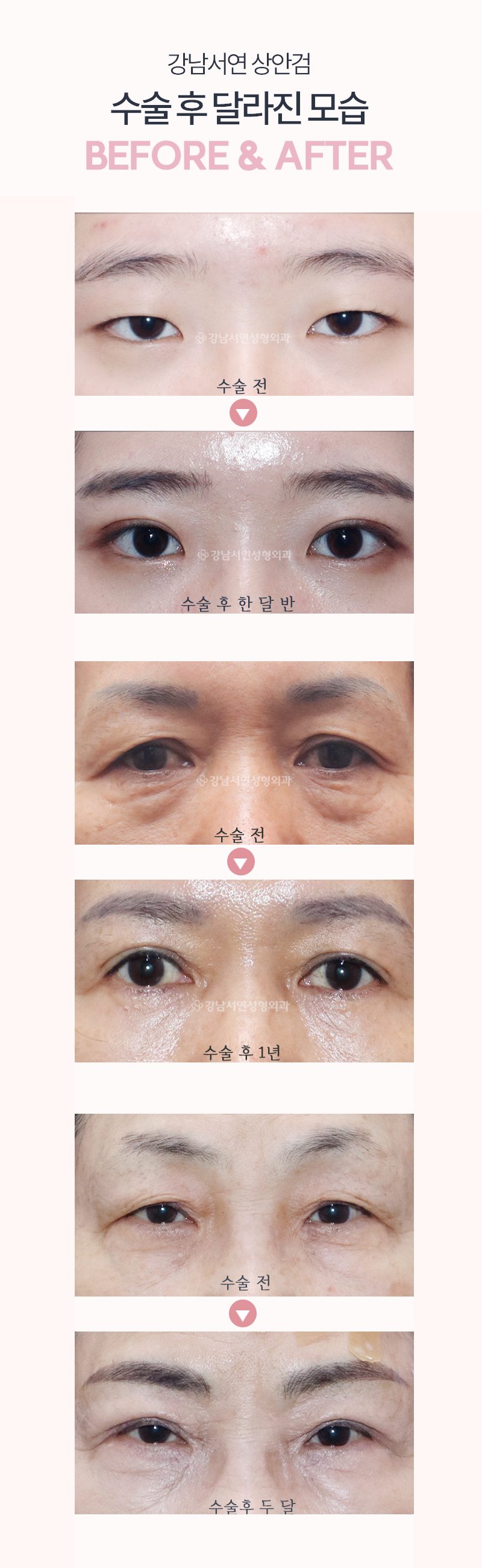 처진 눈꺼풀 끌어올려↗↗↗  상안검 수술하세요~