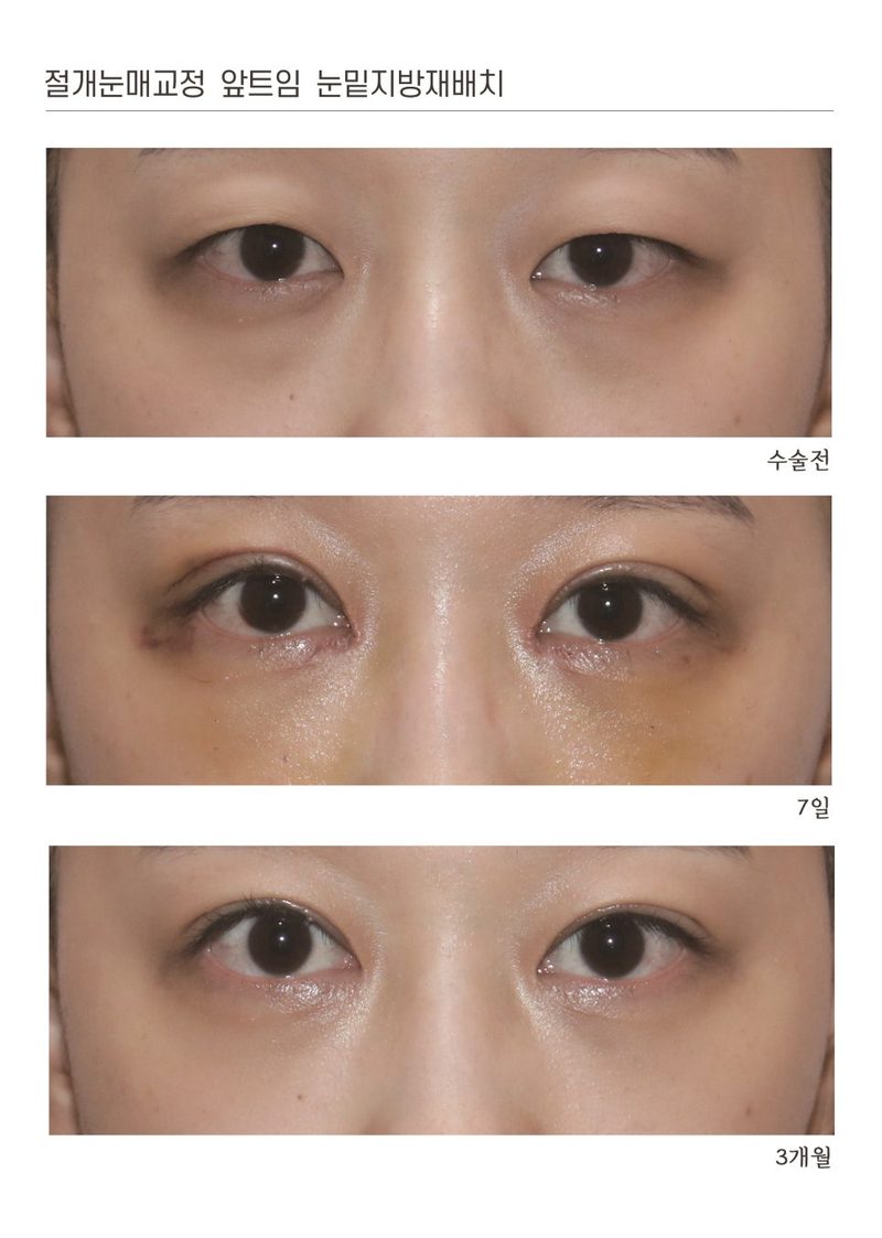 눈밑지방제거도 키닥터와 상의하세요~