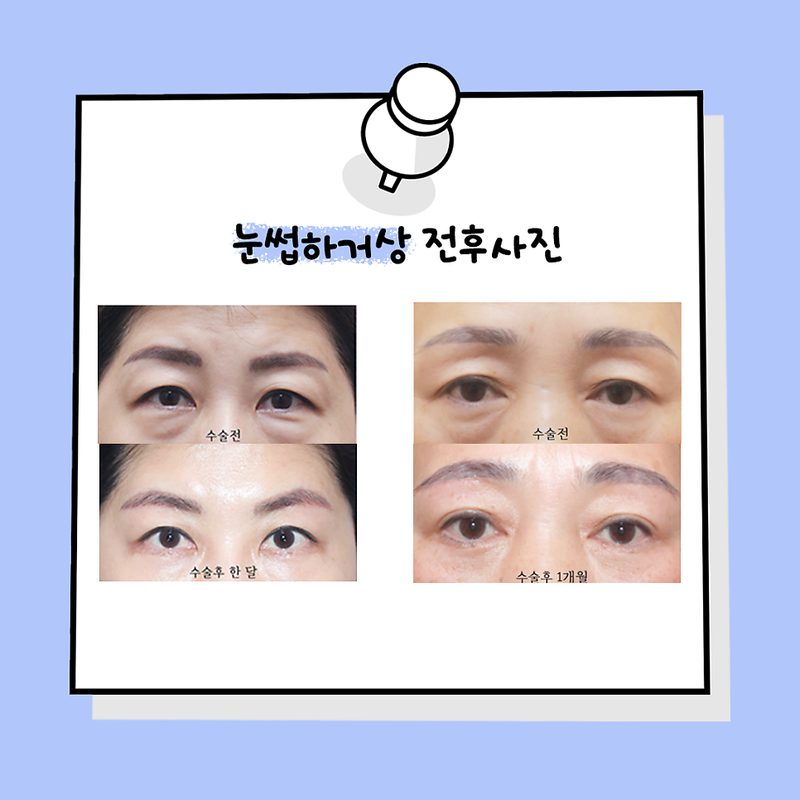 [카드뉴스]눈꺼풀 처짐도 강남서연에서 해결_ 상안검 VS 눈썹하거상