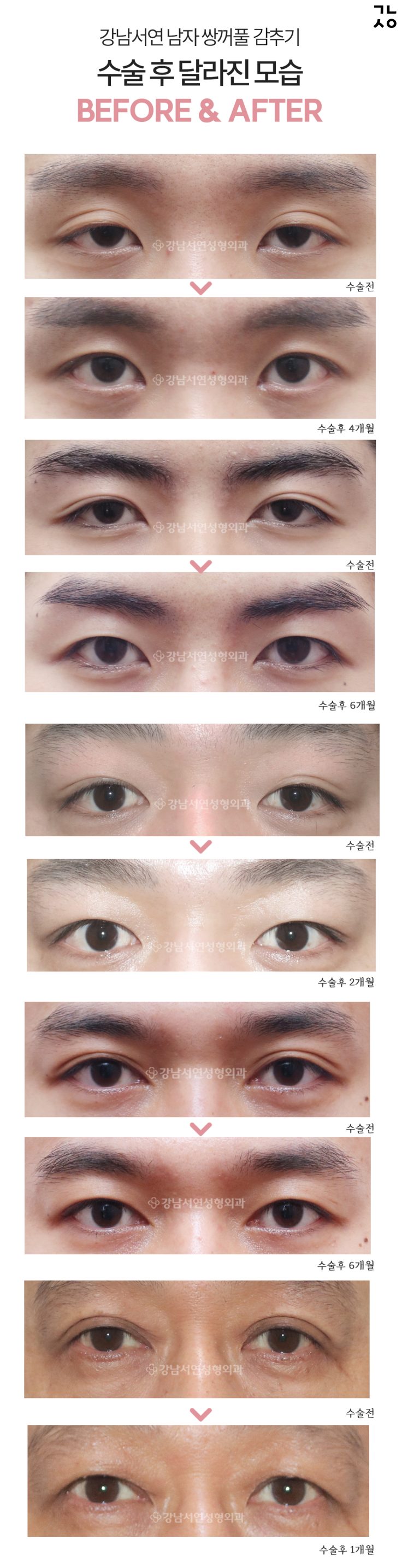 느끼한 남자눈 무쌍수술로 담백하게