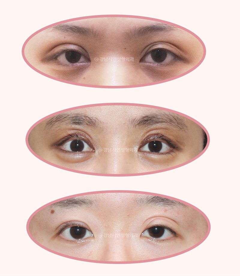 신사동 성형외과 극한눈 악성 눈겹주름 원인, 해결방법