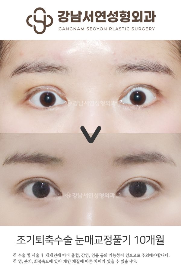 쌍꺼풀 조기교정은 언제 누가 할까? 빠른 판단이 중요