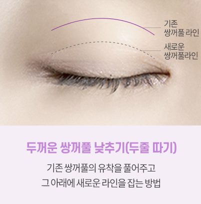 망친 두줄따기도 재수술이 가능할까