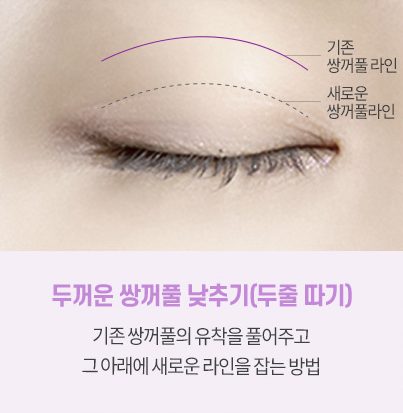 두줄따기 소세지눈재수술 (피부절제 유무/한줄따기/수술대상)
