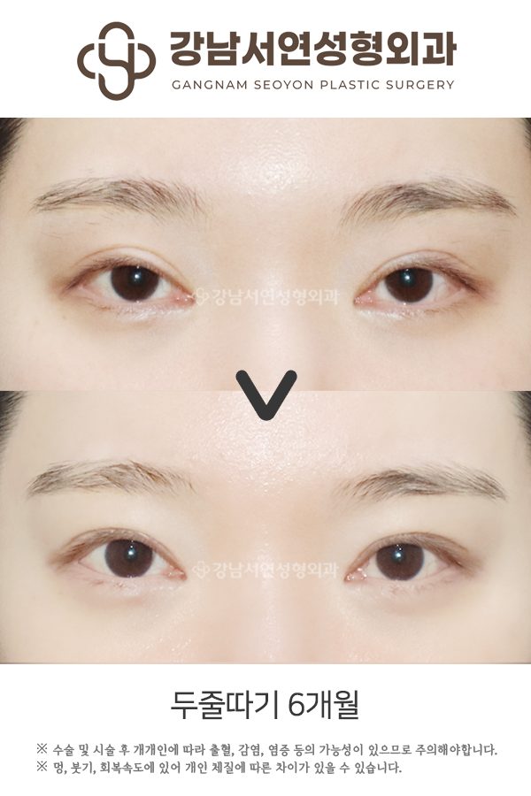 두줄따기 부작용 종류 3가지와 실패 없는 눈재수술 예방법 총정리