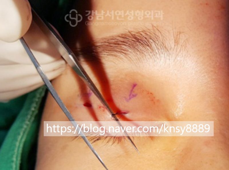 매몰실풀기(매몰실 제거), 절개 없이 가능할까요? 원인부터 회복까지 총정리