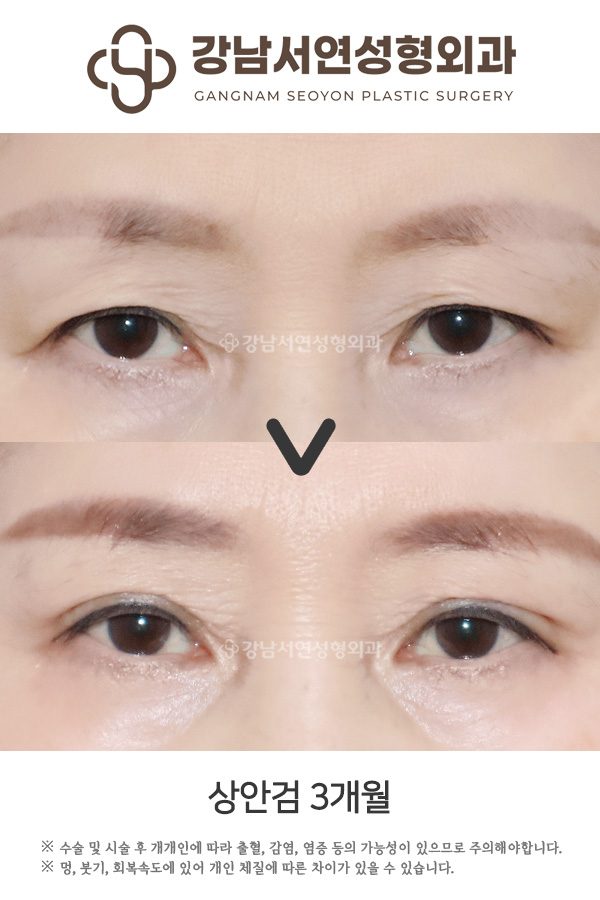 상안검, 눈썹하거상 차이? 처진 눈매 중년눈성형 잘하는 병원