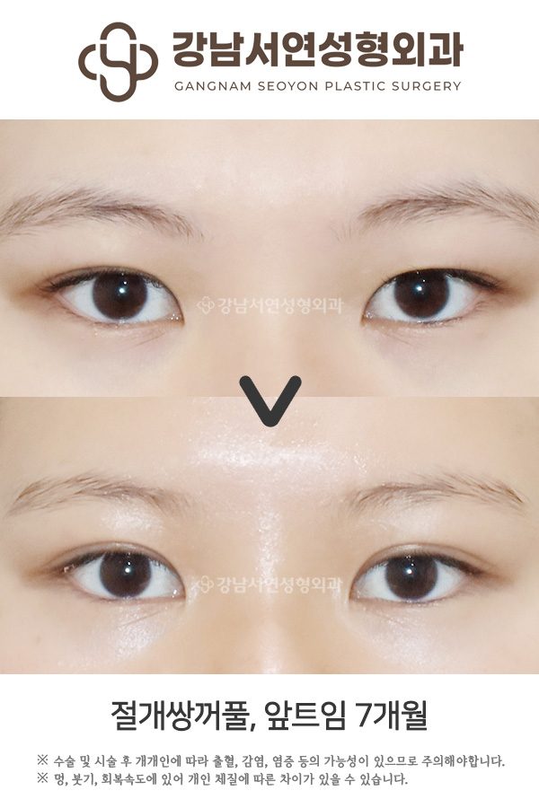 쌍꺼풀수술 매몰법 vs 절개법 차이, 첫 눈성형이라면 꼭 알아야 할 기준