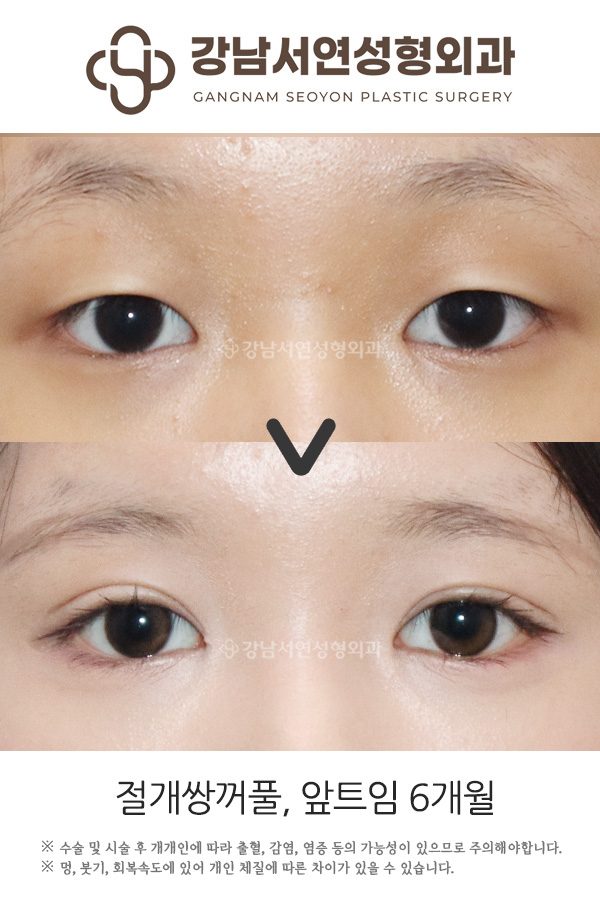 쌍꺼풀수술 vs 눈매교정, 나에게 맞는 건? 첫 눈성형 전 헷갈리는 수술 구분법