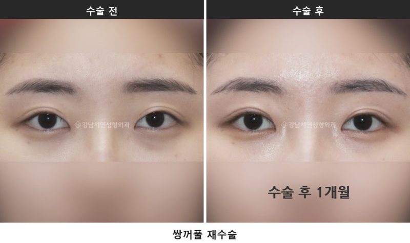 쌍수 재수술, 상담에서 자주 묻는 질문 7가지를 정리했습니다