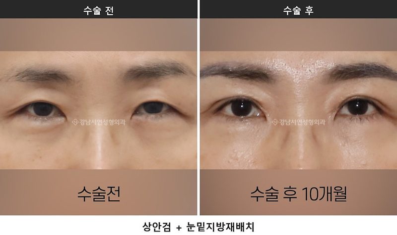 중년 눈 밑이 불룩하고 그늘져 보인다면, 눈밑지방재배치와 하안검 중 무엇