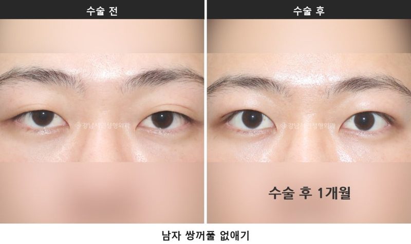 남자 쌍꺼풀 제거, 진료실에서 자주 나오는 질문을 정리했습니다