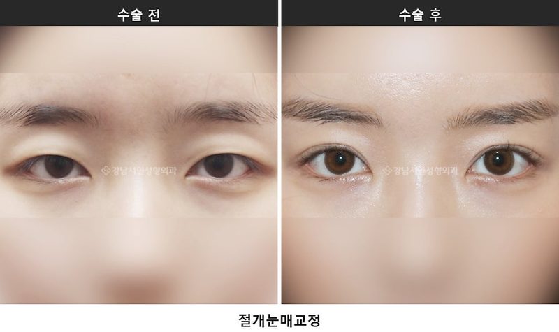 눈매교정술, 눈 뜨는 힘을 바로잡는 수술입니다