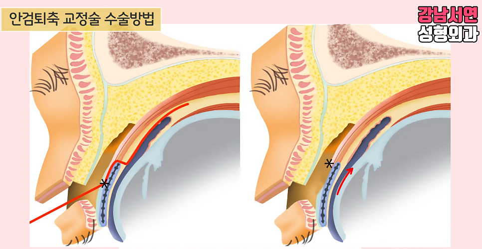 쌍꺼풀 재수술 설명 도해