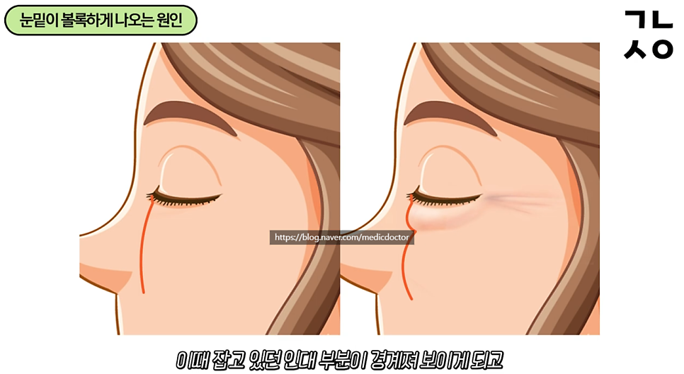 하안검성형 설명 도해