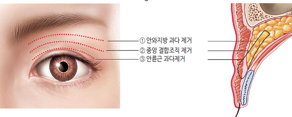 두줄따기 설명 도해